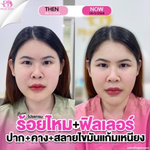 สินค้า ประกาศ เสริมความงามอุด อุดร-ฉีดโบท็อก ลดริ้วรอย ยกกระชับ ฉีดฟิลเลอร์อุดรธานี